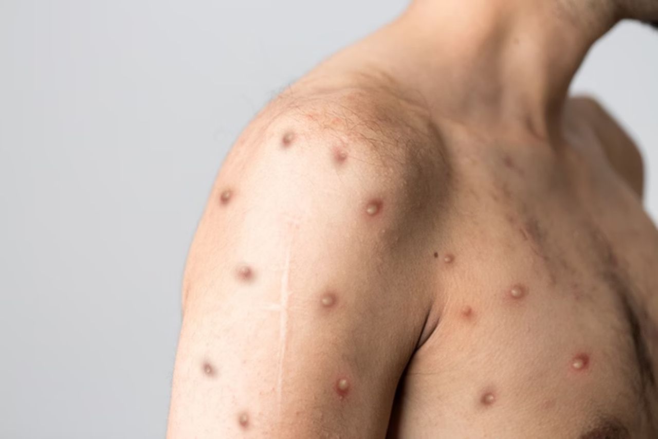 Cidade de São Paulo registra 35 novos casos de mpox em uma semana
