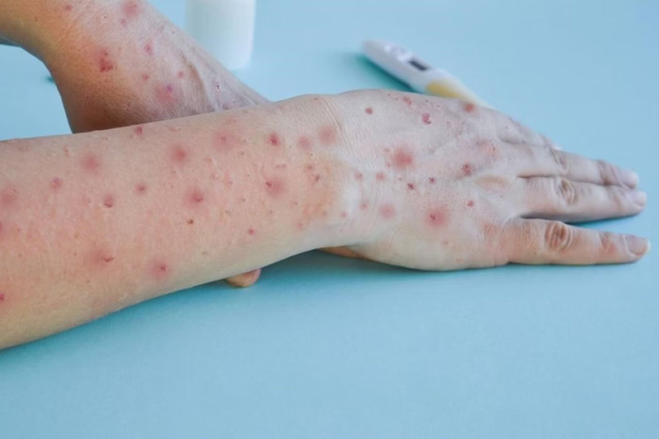 Cidade de SP registra 241 casos de mpox de janeiro a agosto