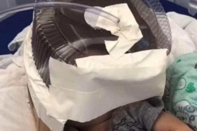 Morre bebê que usou respirador improvisado com embalagem de bolo