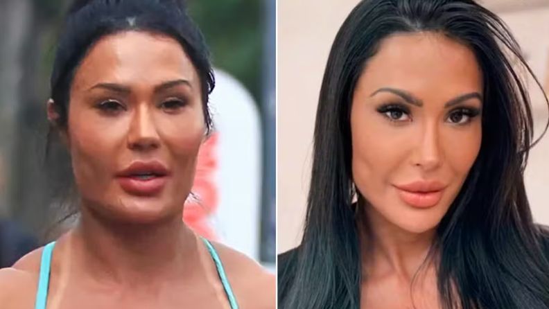 Gracyanne Barbosa passa por reversão de procedimentos no mostro e mostra resultado