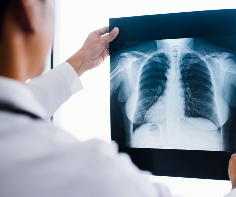 Saiba mais sobre a Fibrose Cística: condição genética que afeta pulmões e sistema digestivo
