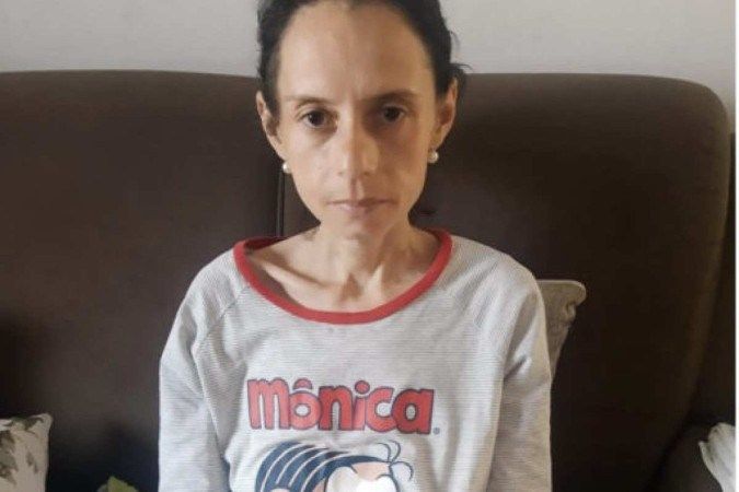 Mulher vai fazer reversão de cirurgia bariátrica após pesar 36kg