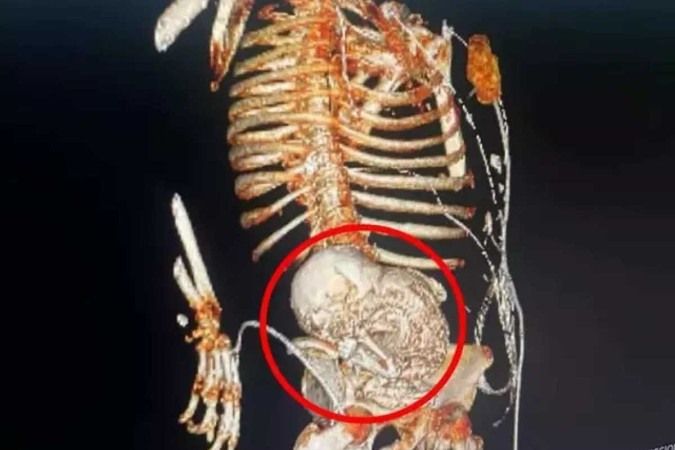 'Grávida' por 5 décadas: médicos descobrem feto calcificado em mulher