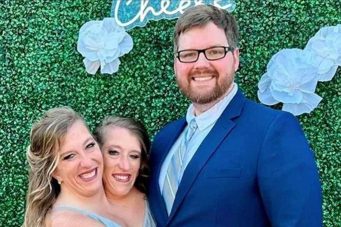 Gêmea siamesa, unida pelo tórax com a irmã, se casa nos Estados Unidos