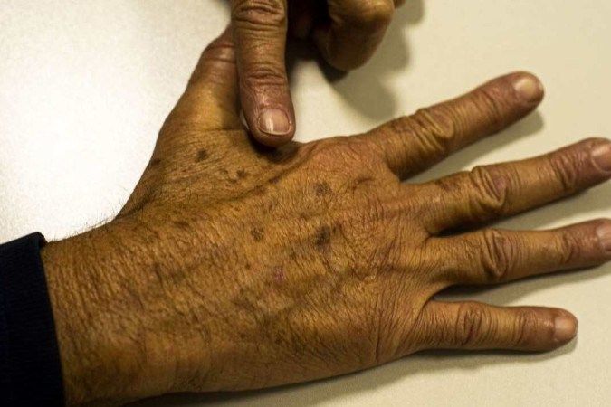 Campanha sobre o câncer de pele chama atenção para os sinais de alerta