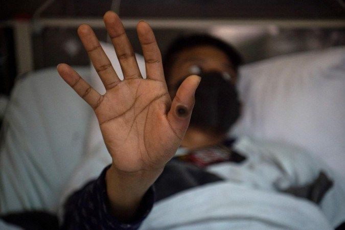 Brasil fica em alerta com nova ameaça da mpox; entenda a doença