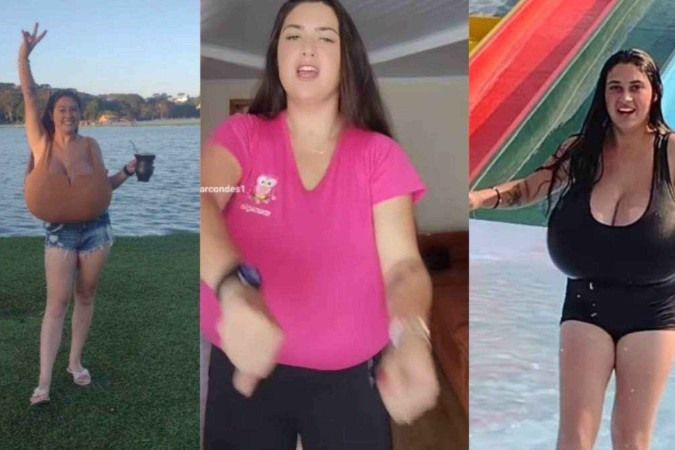 Jovem com gigantomastia retira 10 kg de mama: 'Minha coluna estava horrível'