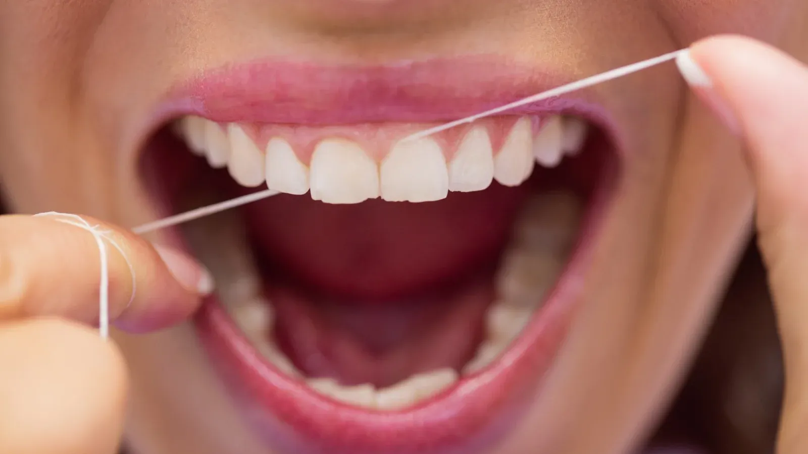 Pesquisa revela que uso frequente de fio dental pode reduzir o risco de AVC