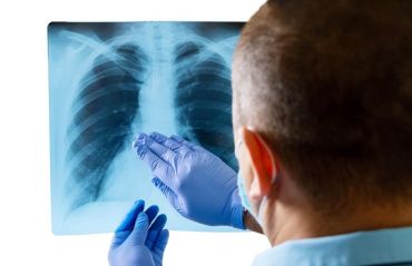 Unidades de Saúde realizam Dia D para identificar casos de tuberculose em Maceió