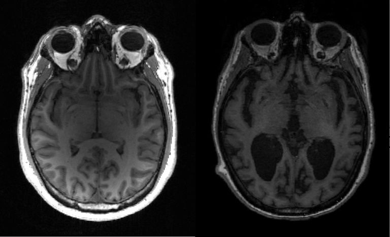 Remédio contra Alzheimer se provou eficaz, diz painel da FDA