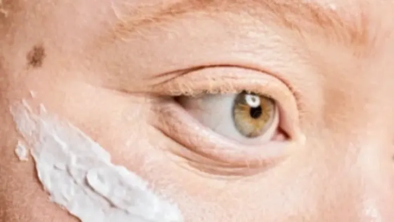 Maceió garante protetor solar gratuito para pessoas com albinismo