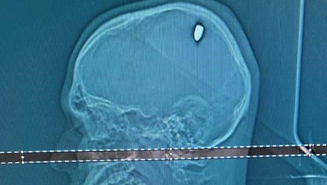 Jovem levou tiro em festa de réveillon e conta só ter descoberto bala na cabeça após 4 dias