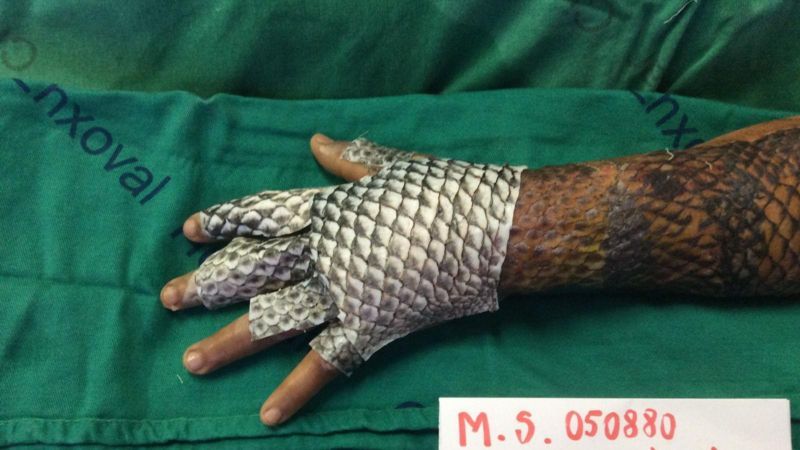 Brasileiros testam pele de tilápia como tratamento para queimadura e em cirurgias de mudança de sexo
