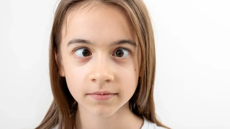 Estrabismo em crianças pode sinalizar problemas neurológicos, alerta especialista