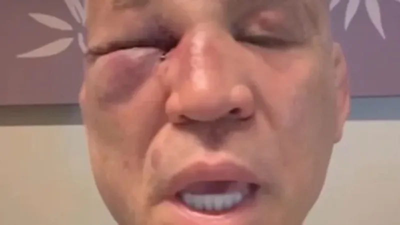 Wanderlei Silva mostra sequelas de agressão e promete ir à Justiça