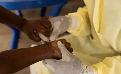 Agência da ONU para migrações pede US$ 18,5 bi para combater mpox