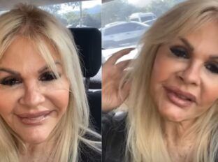 Monique Evans mostra rosto sem filtro após harmonização facial