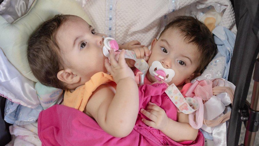 Gêmeas siamesas são internadas para cirurgia de separação