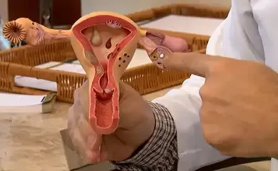 Endometriose: conheça os sintomas e saiba como tratar a doença