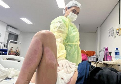 HGE alerta para os riscos causados por queimaduras e recomenda atenção também dentro de casa