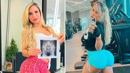 Candidata ao Miss Bumbum prova com raio-x que bumbum é natural