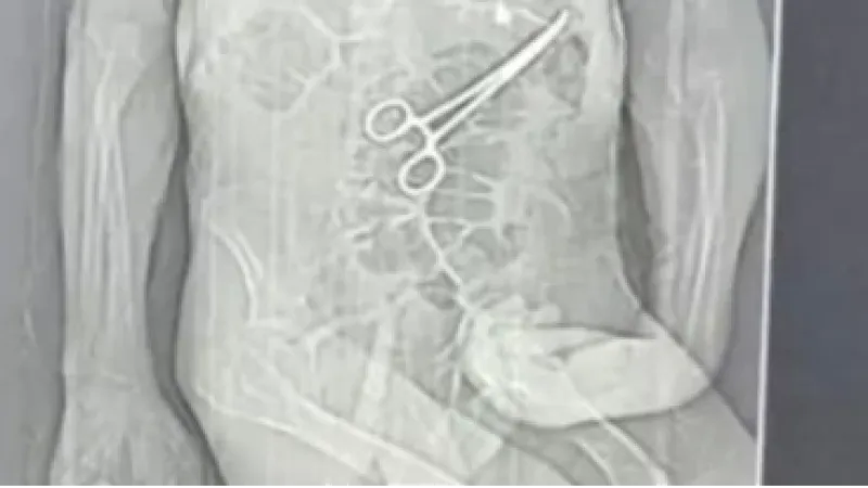 Homem morre na véspera do Natal e família diz que pinça foi deixada em seu corpo