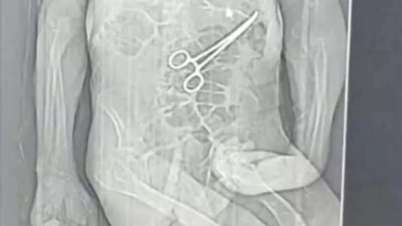 Secretaria de Saúde investiga morte de idoso que teve instrumento cirúrgico esquecido dentro do corpo em MG