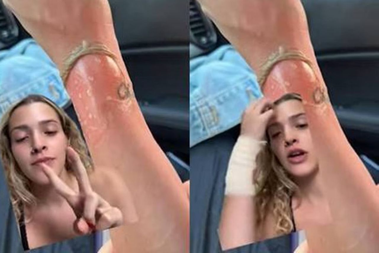 Jovem tem queimadura ao coar café direto no copo Stanley: “Explodiu”