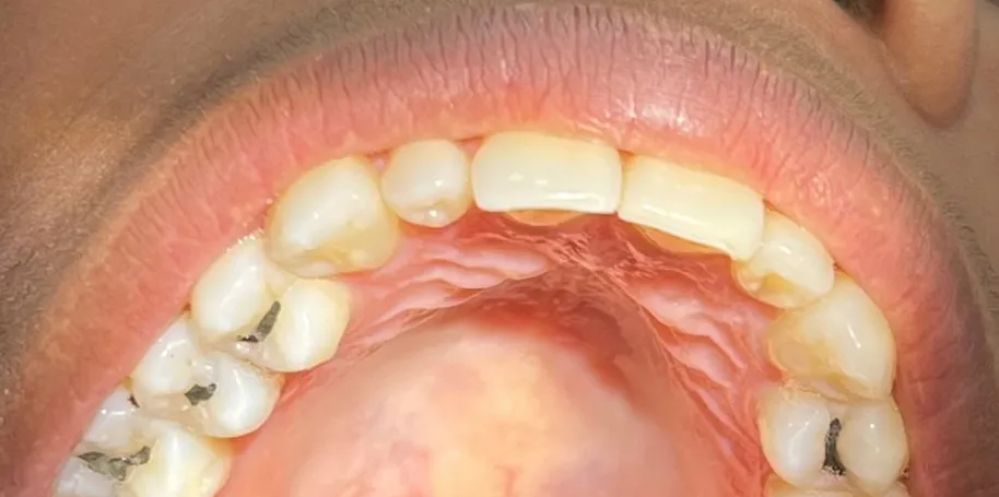 Alesp segue norma da Anvisa e proíbe uso de amálgama de mercúrio na odontologia