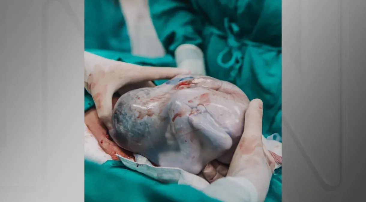 Em evento raro, mulher dá à luz gêmeos e um dos bebês nasce com bolsa amniótica intacta