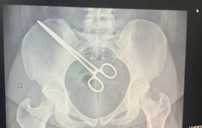 Mulher descobre pinça dentro do corpo ao visitar marido na cadeia