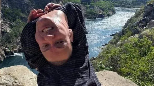 “Não vejo nada de cabeça para baixo”, diz baiano portador de rara doença congênita