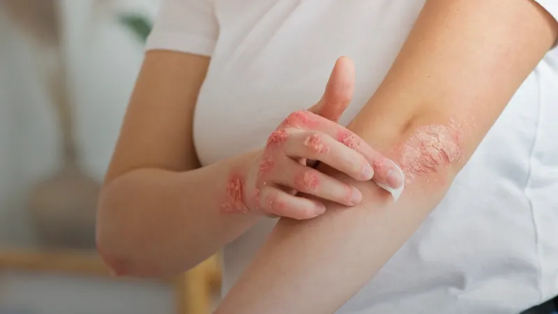 Dia Mundial da Psoríase reforça que a doença não é contagiosa e tem tratamento