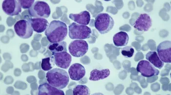 Novo estudo descobre como proteína afeta crescimento de células de câncer