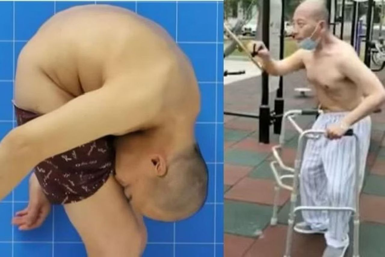 ‘Homem dobrado’ recupera movimentos após 28 anos com coluna curvada