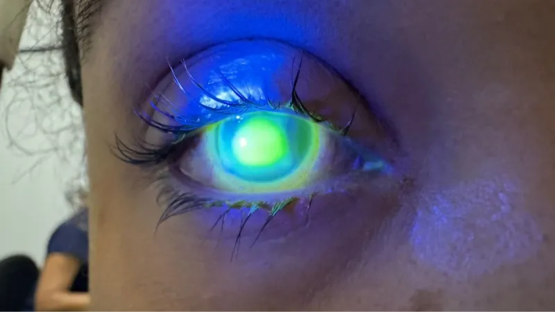 Oftalmologista do HGE alerta sobre o cuidado com os olhos durante o Carnaval