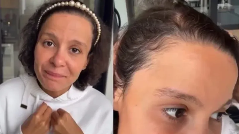 Entenda o que é a alopecia androgenética, condição de Maiara, dupla de Maraísa
