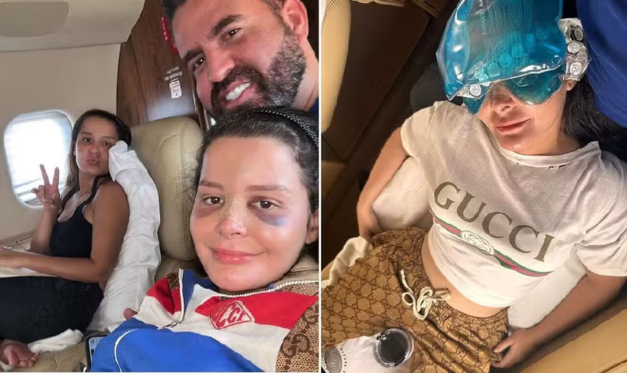 Maraísa posta foto de nariz quebrado e fala sobre acidente em piscina de resort em AL: 'Era pra ser uma simples folga'