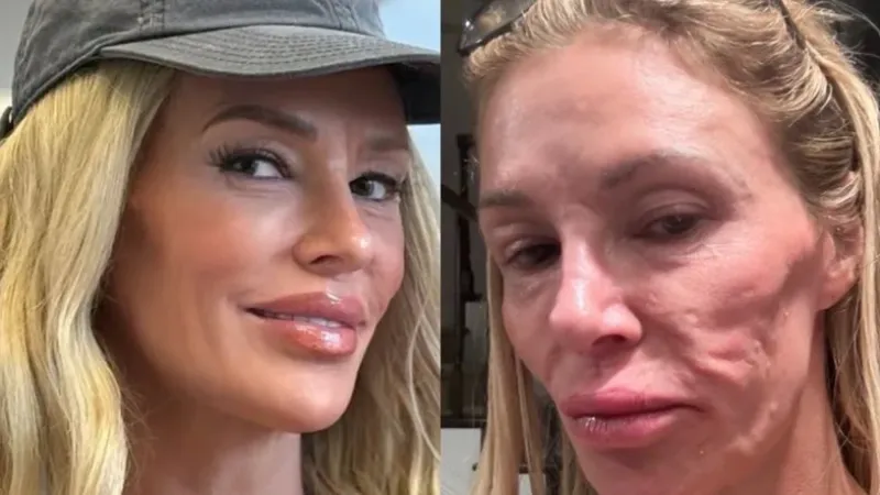 Ex-modelo que teve rosto ‘derretido’ por parasita mostra resultado de plástica