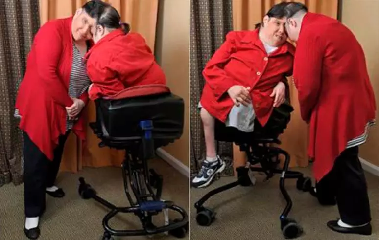 Gêmeos siameses mais velhos do mundo morrem aos 62 anos