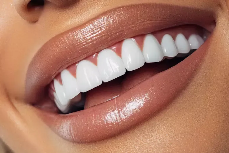 Dia do Riso: facetas de cerâmica nos dentes são para todos?