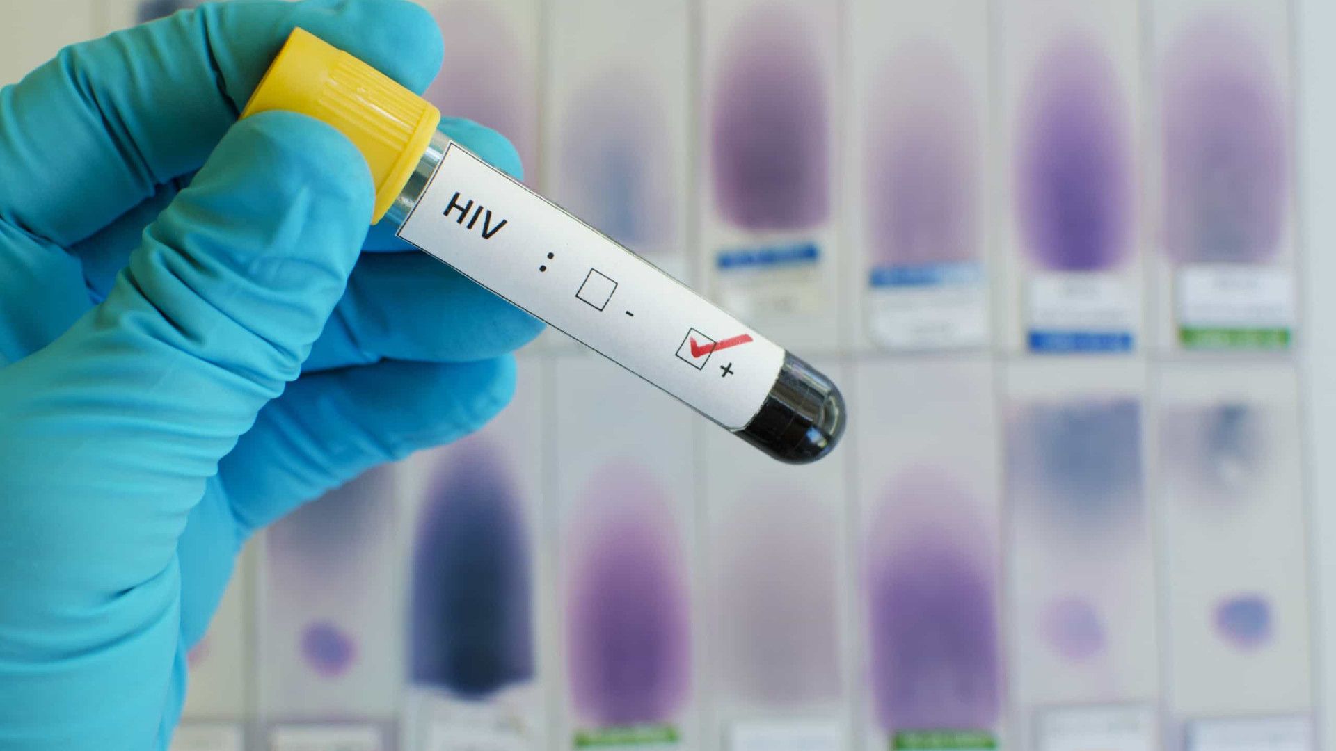Nova variante do HIV é detectada na Bahia, no Rio de Janeiro e no Rio Grande do Sul
