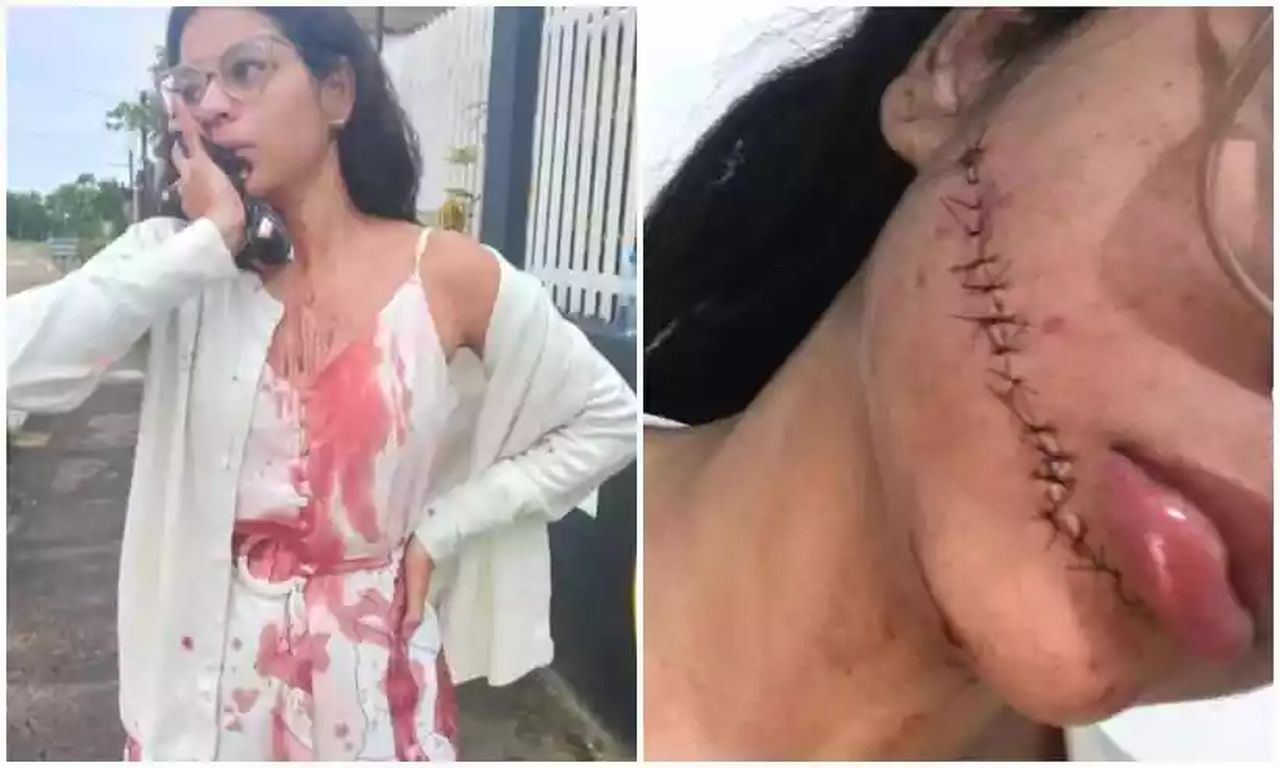 Jovem tem rosto cortado na Bahia enquanto dormia em viagem de ônibus