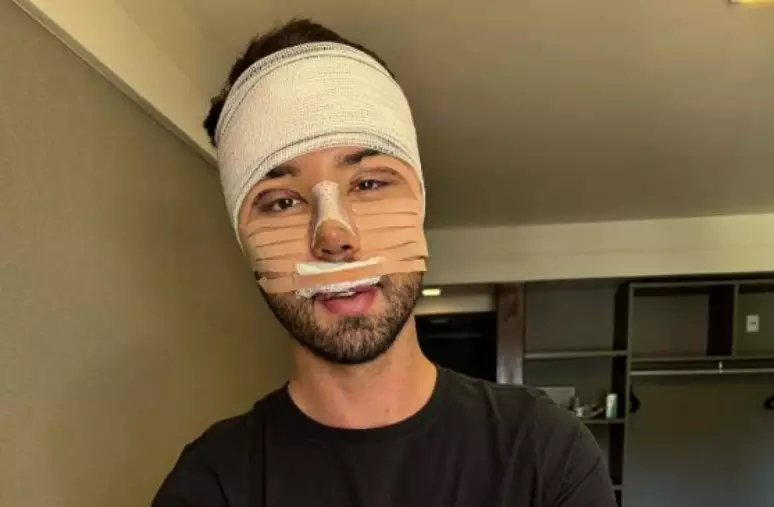 Rico desabafa após cirurgias no rosto: "Não aguentava mais ser chamado de feio"
