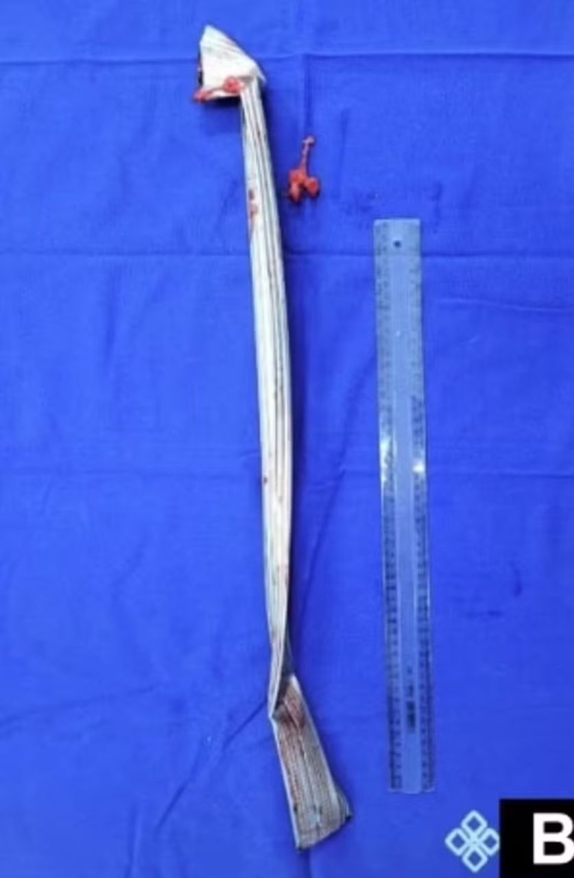 Curitibano cai de andaime e escapa da morte por pouco após barra de ferro de um metro atravessar seu corpo