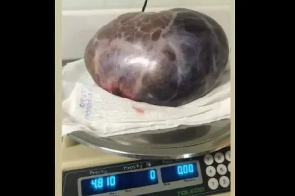 Em cirurgia de emergência, médicos retiram tumor de 5 kg de paciente