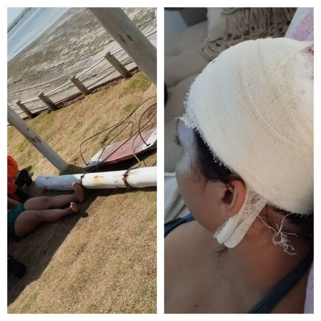 Professora leva mais de 10 pontos na cabeça após pedaço de balanço cair na Ponta Verde, em Maceió