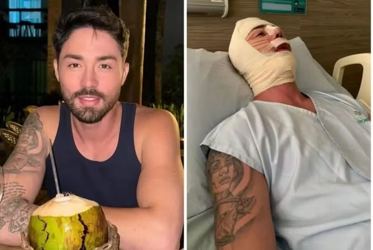 Rico Melquiades passa por 11ª cirurgia no rosto: 'Vocês irão se surpreender'
